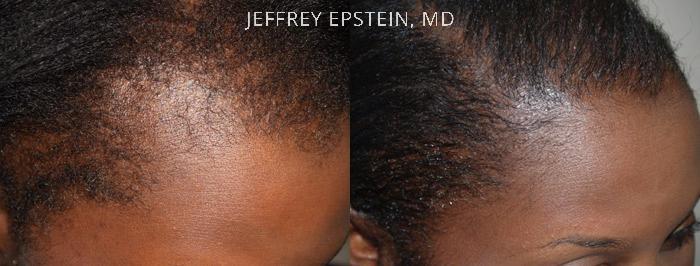 Forehead Reduction Surgery Before and after in Miami, FL, Paciente 37277