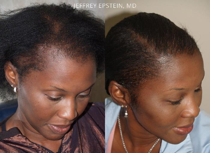 Forehead Reduction Surgery Before and after in Miami, FL, Paciente 37277