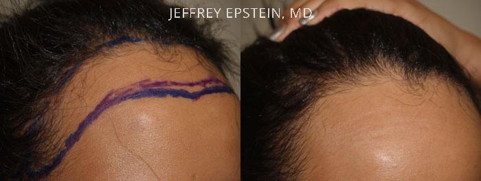 Forehead Reduction Surgery Before and after in Miami, FL, Paciente 37291