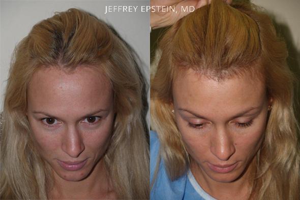 Hairline Advancement Before and after in Miami, FL, Paciente 37296