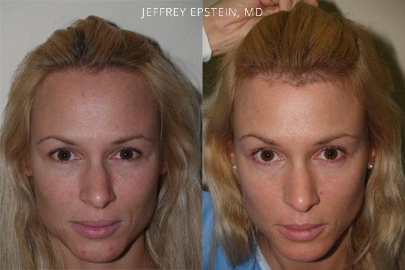 Forehead Reduction Surgery Before and after in Miami, FL, Paciente 37296