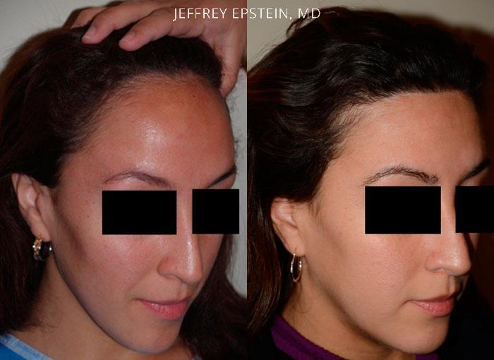Forehead Reduction Surgery Before and after in Miami, FL, Paciente 37307