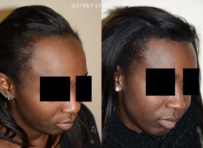 Forehead Reduction Surgery Before and after in Miami, FL, Paciente 37310