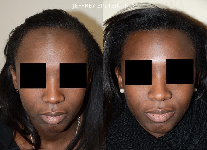 Hairline Advancement Before and after in Miami, FL, Paciente 37310