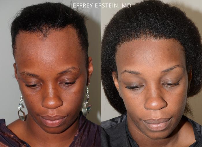 Forehead Reduction Surgery Before and after in Miami, FL, Paciente 37317