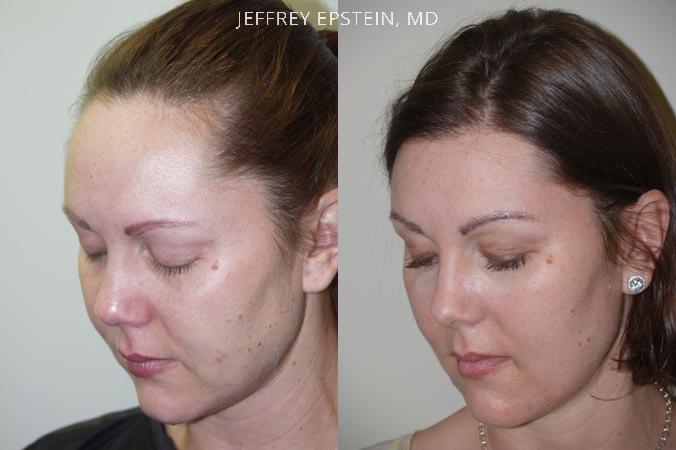 Forehead Reduction Surgery Before and after in Miami, FL, Paciente 37322