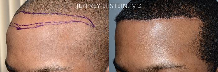 Hairline Advancement Before and after in Miami, FL, Paciente 37340
