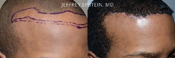 Forehead Reduction Surgery Before and after in Miami, FL, Paciente 37340