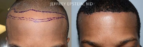 Forehead Reduction Surgery Before and after in Miami, FL, Paciente 37340