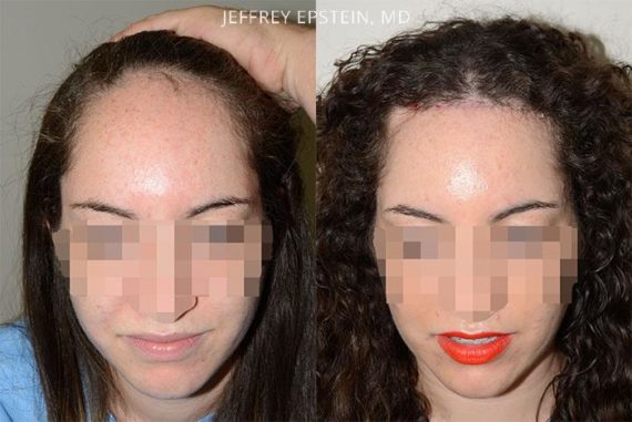 Forehead Reduction Surgery Before and after in Miami, FL, Paciente 37347