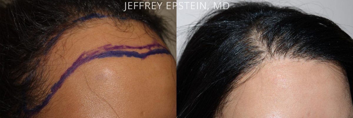 Hairline Advancement Before and after in Miami, FL, Paciente 37354