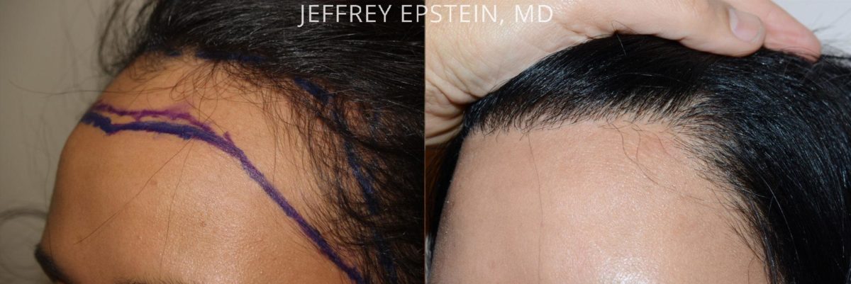 Hairline Advancement Before and after in Miami, FL, Paciente 37354