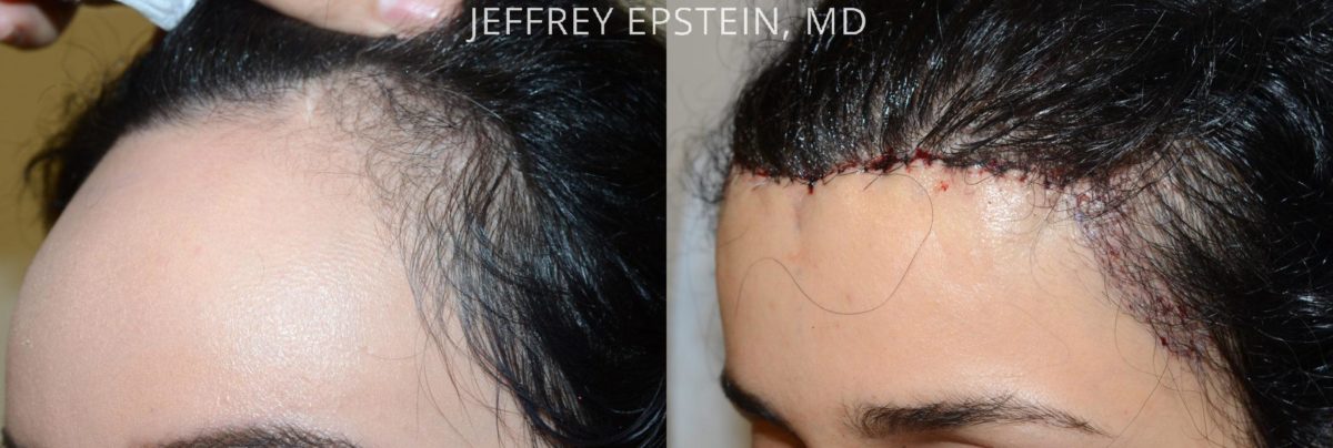 Hairline Advancement Before and after in Miami, FL, Paciente 37359