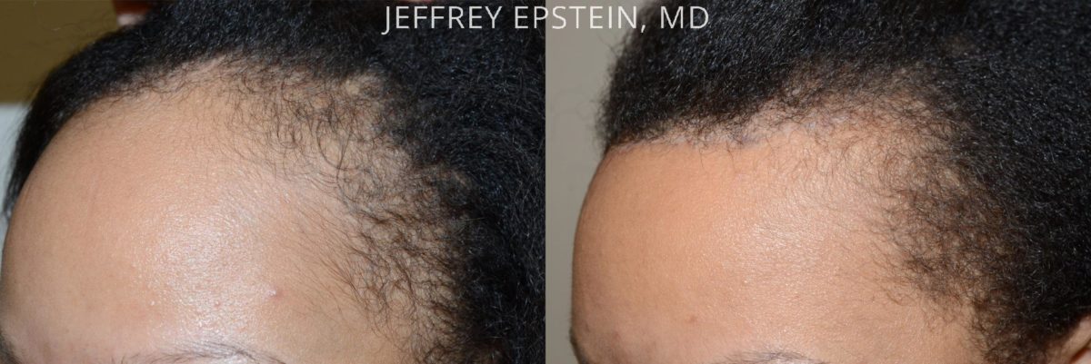 Forehead Reduction Surgery Before and after in Miami, FL, Paciente 37362