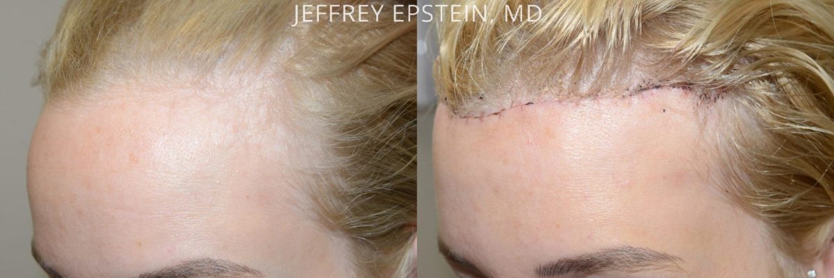 Forehead Reduction Surgery Before and after in Miami, FL, Paciente 37369