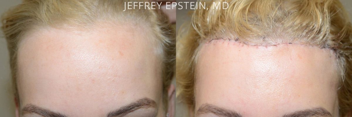 Forehead Reduction Surgery Before and after in Miami, FL, Paciente 37369