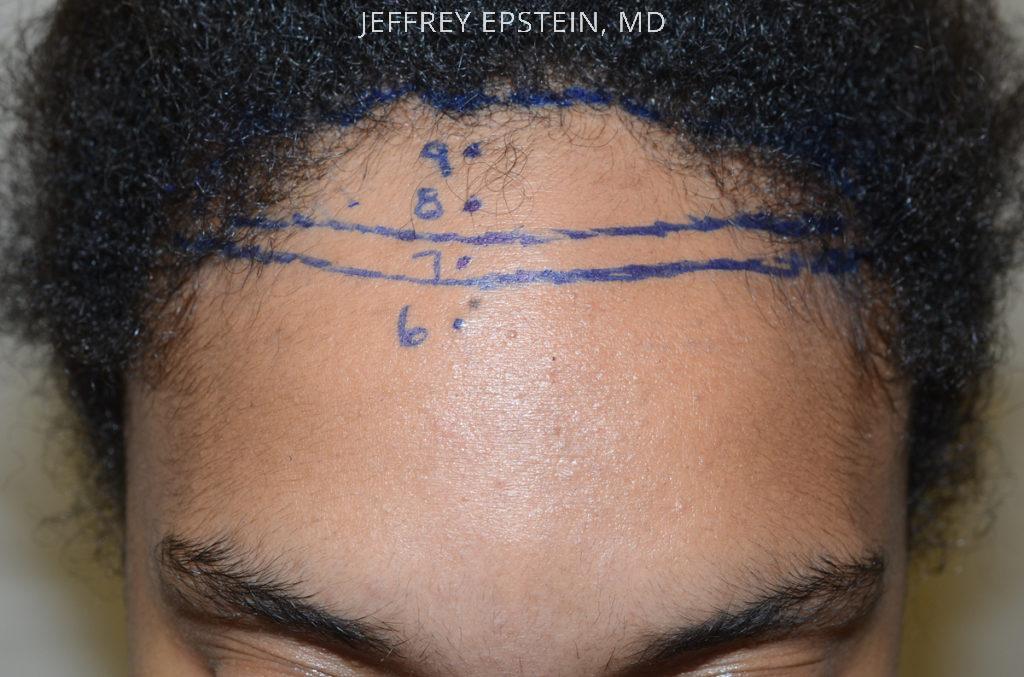 Forehead Reduction Surgery Before and after in Miami, FL, Paciente 37376