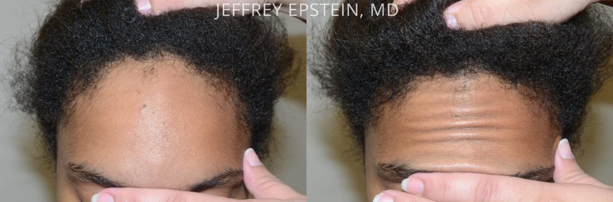 Forehead Reduction Surgery Before and after in Miami, FL, Paciente 37376