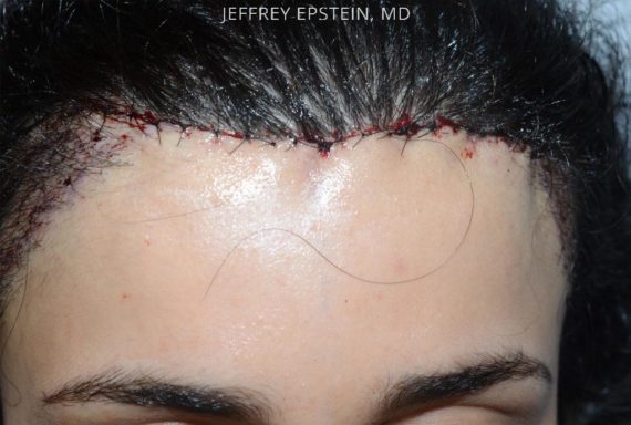 Forehead Reduction Surgery Before and after in Miami, FL, Paciente 37380
