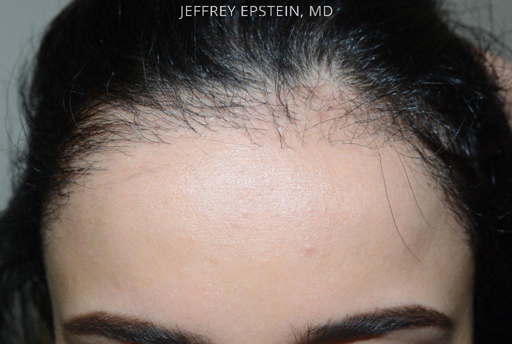 Forehead Reduction Surgery Before and after in Miami, FL, Paciente 37380