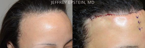 Hairline Advancement Before and after in Miami, FL, Paciente 37385