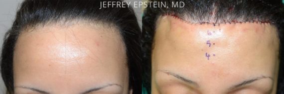 Hairline Advancement Before and after in Miami, FL, Paciente 37385