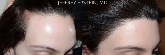 Forehead Reduction Surgery Before and after in Miami, FL, Paciente 37392