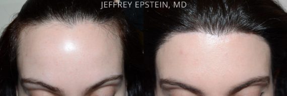 Hairline Advancement Before and after in Miami, FL, Paciente 37392