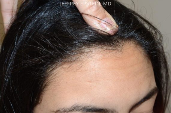 Forehead Reduction Surgery Before and after in Miami, FL, Paciente 37399