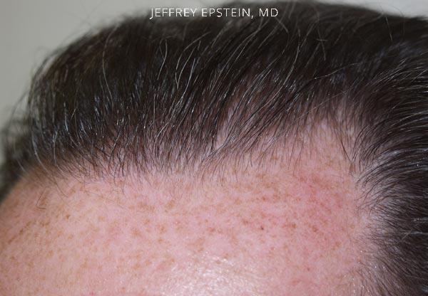 Hairline Closeups Before and after in Miami, FL, Paciente 37405