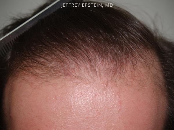 Hairline Transplant Closeups Before and after in Miami, FL, Paciente 37407
