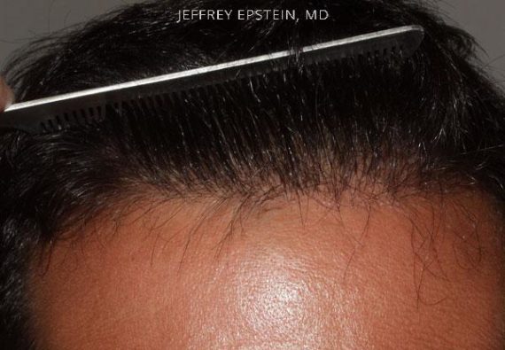 Hairline Transplant Closeups Before and after in Miami, FL, Paciente 37413