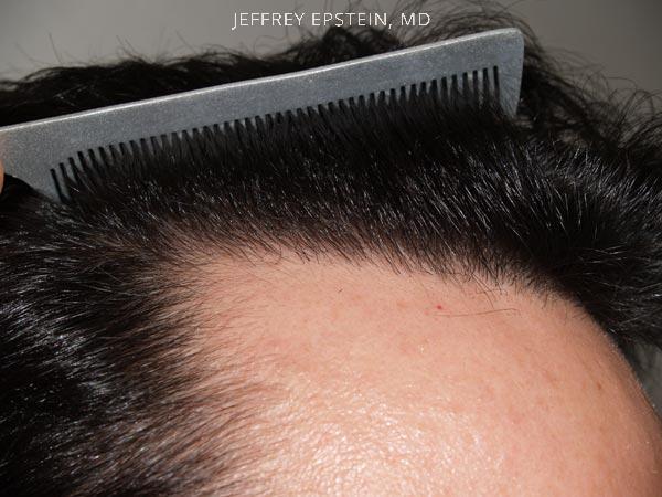 Hairline Transplant Closeups Before and after in Miami, FL, Paciente 37415