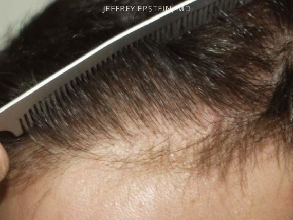 Hairline Transplant Closeups Before and after in Miami, FL, Paciente 37417