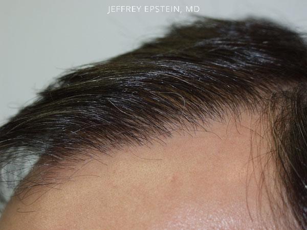 Hairline Closeups Before and after in Miami, FL, Paciente 37419