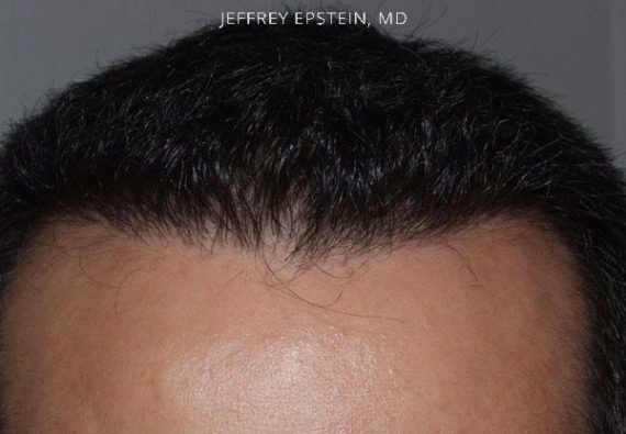 Hairline Transplant Closeups Before and after in Miami, FL, Paciente 37421