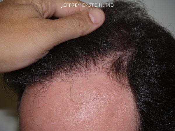 Hairline Transplant Closeups Before and after in Miami, FL, Paciente 37423
