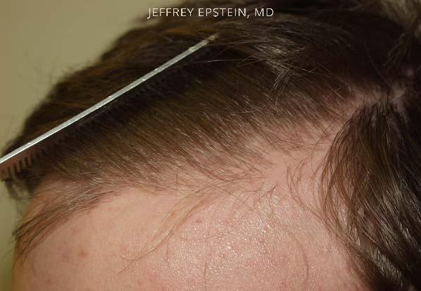 Hairline Transplant Closeups Before and after in Miami, FL, Paciente 37425