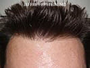 Hairline Transplant Closeups Before and after in Miami, FL, Paciente 37427