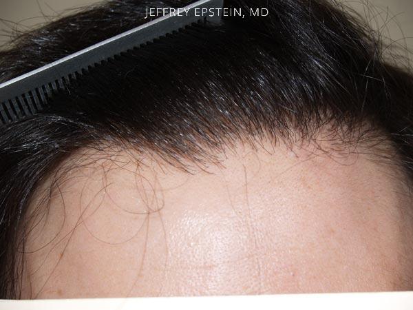 Hairline Transplant Closeups Before and after in Miami, FL, Paciente 37429