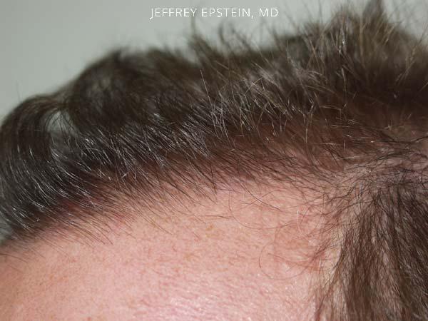 Hairline Transplant Closeups Before and after in Miami, FL, Paciente 37431