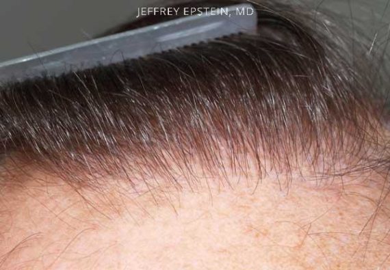Hairline Transplant Closeups Before and after in Miami, FL, Paciente 37433