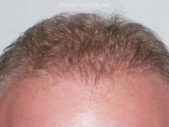 Hairline Transplant Closeups Before and after in Miami, FL, Paciente 37435