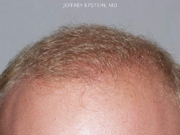 Hairline Transplant Closeups Before and after in Miami, FL, Paciente 37437