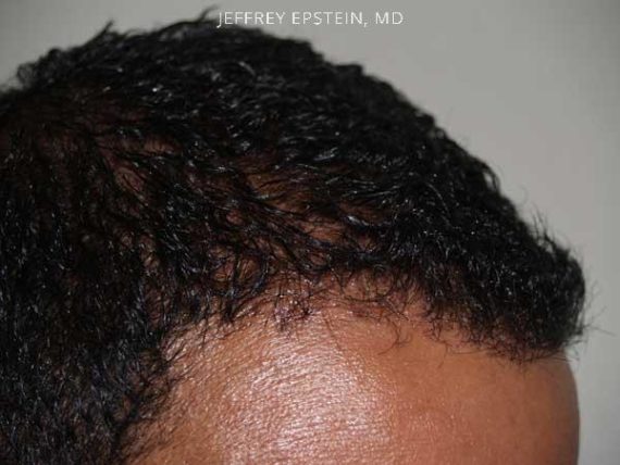 Hairline Transplant Closeups Before and after in Miami, FL, Paciente 37439