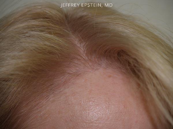 Hairline Transplant Closeups Before and after in Miami, FL, Paciente 37441