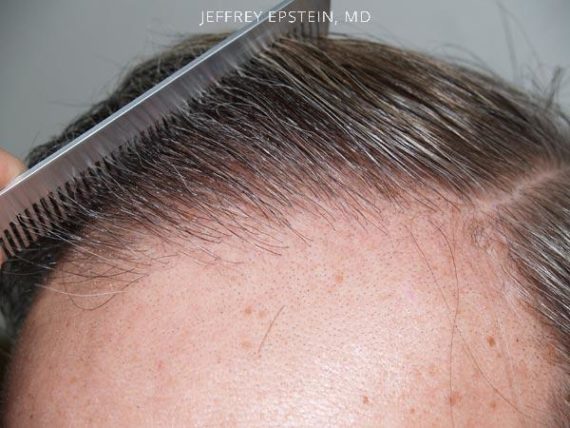 Hairline Closeups Before and after in Miami, FL, Paciente 37443