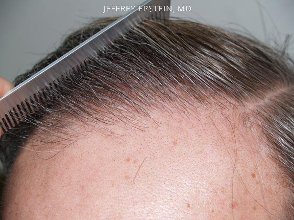 Hairline Transplant Closeups Before and after in Miami, FL, Paciente 37443