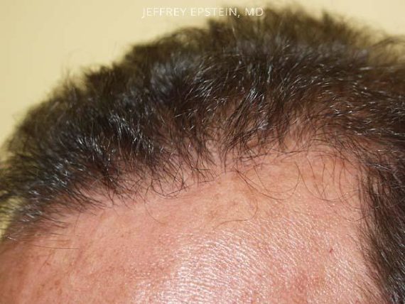 Hairline Closeups Before and after in Miami, FL, Paciente 37445
