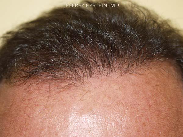 Hairline Transplant Closeups Before and after in Miami, FL, Paciente 37445